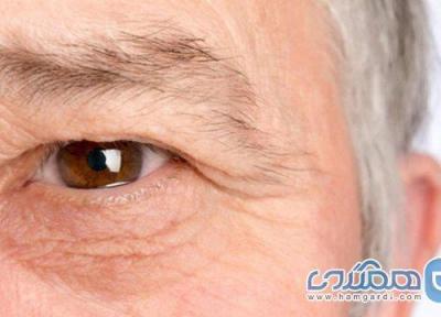 علائم خشکی چشم و روشهای درمان